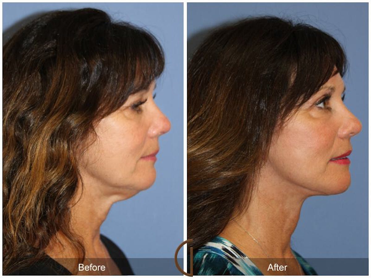 Facelift 50s Before & After Gallery - Patient 146368 - Image 3