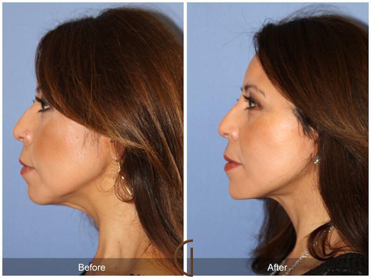 Facelift 50s Before & After Gallery - Patient 235406 - Image 1