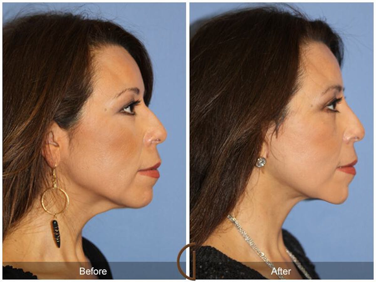 Facelift 50s Before & After Gallery - Patient 235406 - Image 3