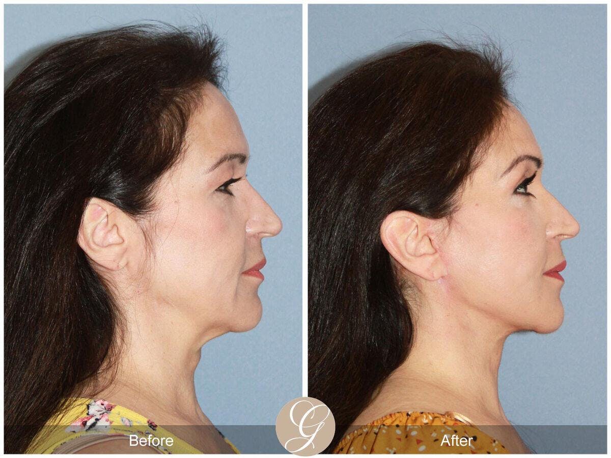 Facelift 50s Before & After Gallery - Patient 425820 - Image 3