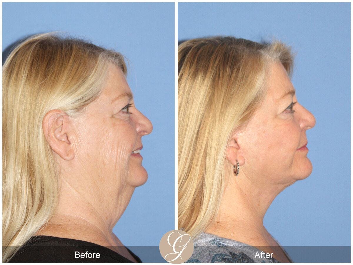 Facelift 60s Before & After Gallery - Patient 252340 - Image 3