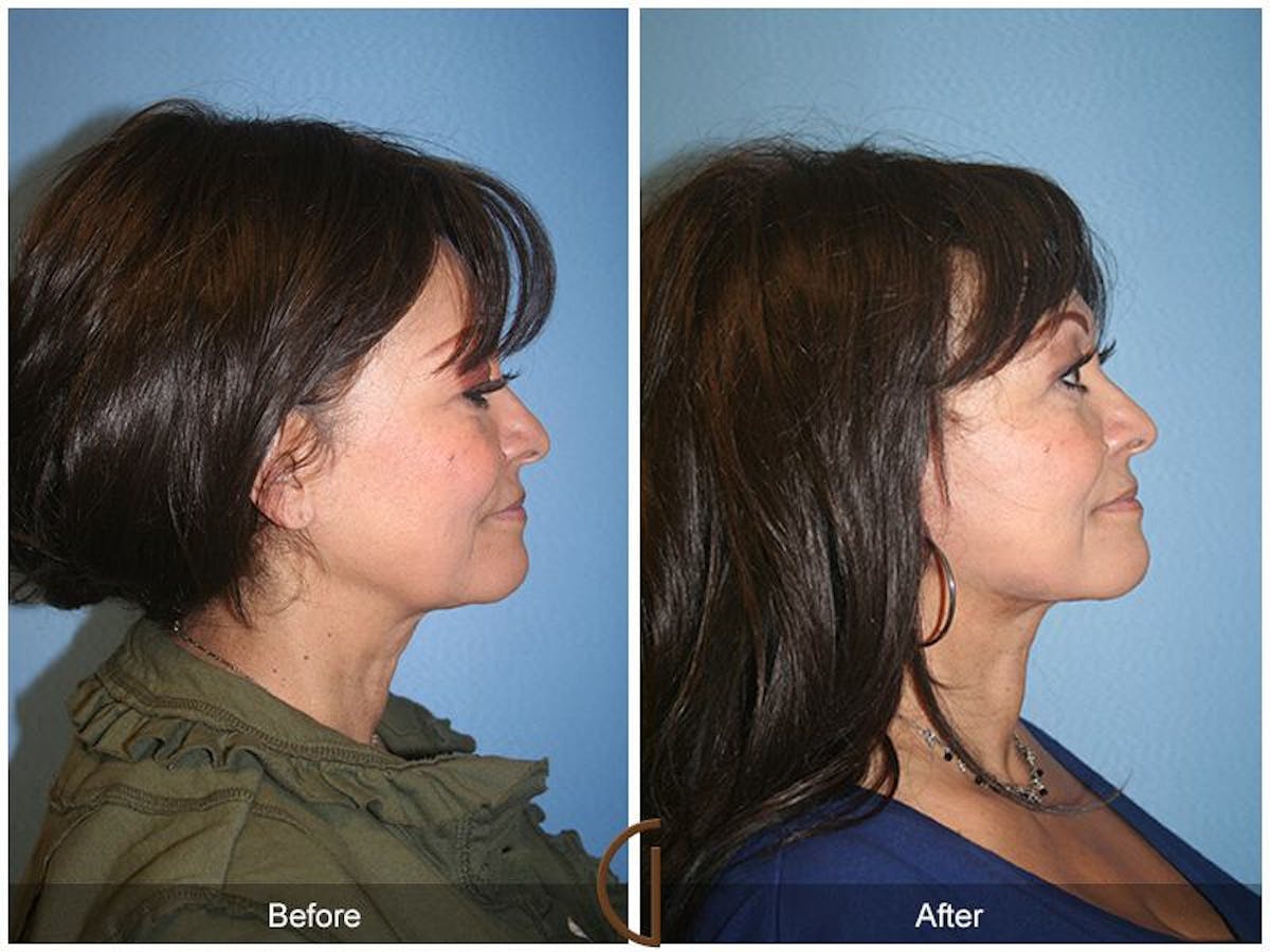Facelift 60s Before & After Gallery - Patient 200584 - Image 3