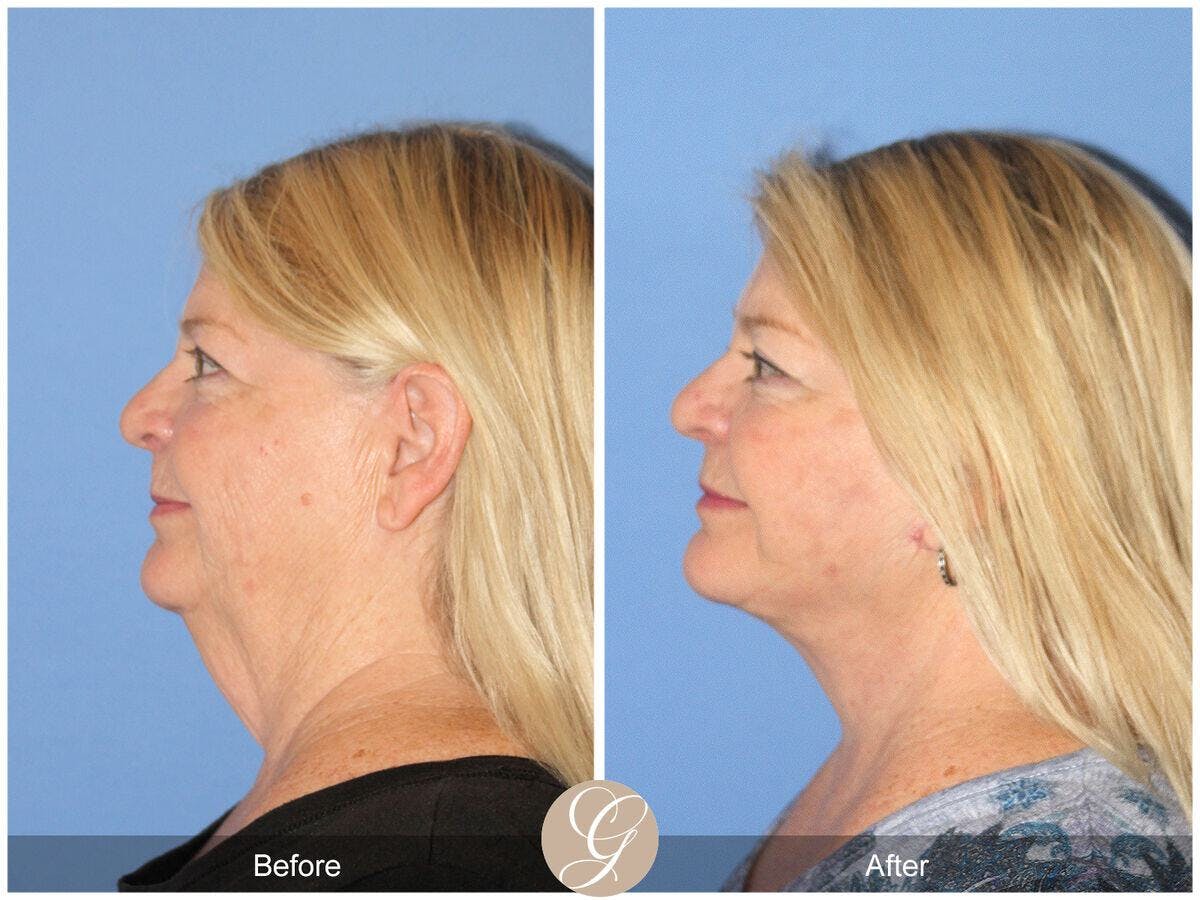 Facelift 60s Before & After Gallery - Patient 252340 - Image 1