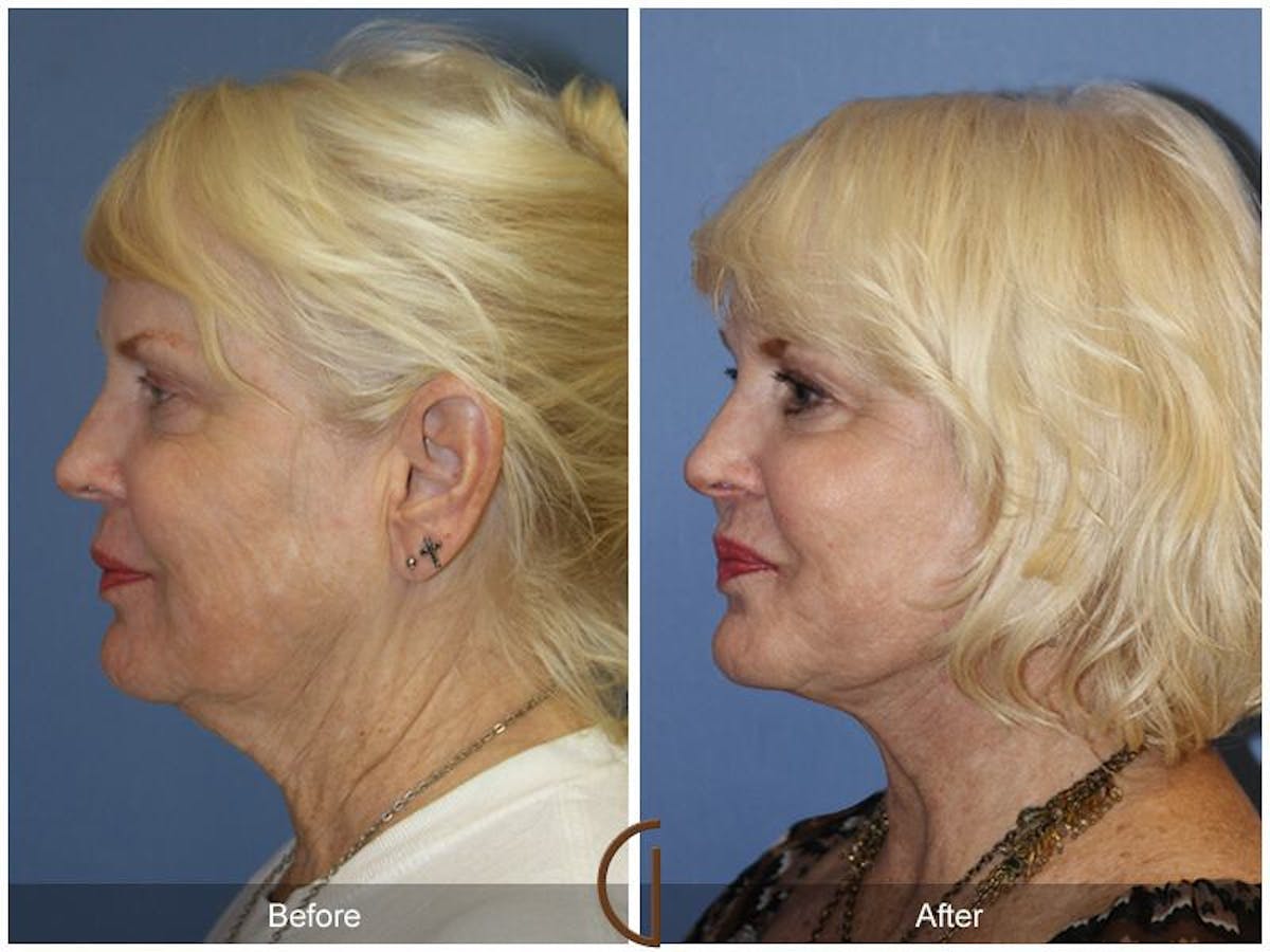 Facelift 60s Before & After Gallery - Patient 726386 - Image 1