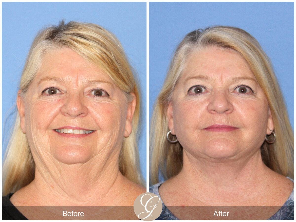 Facelift 60s Before & After Gallery - Patient 252340 - Image 2