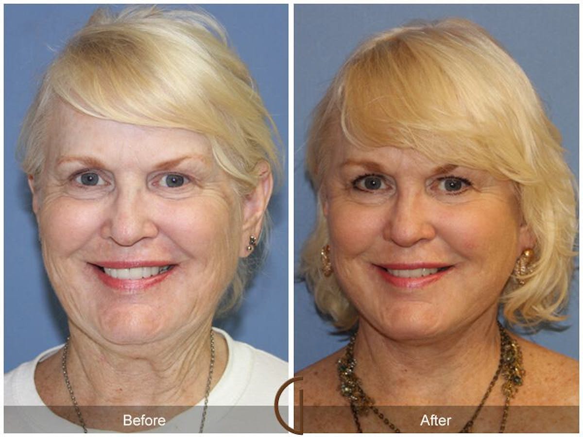 Facelift 60s Before & After Gallery - Patient 726386 - Image 2