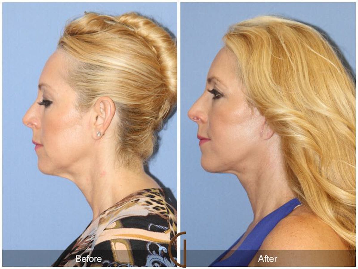 Facelift 50s Before & After Gallery - Patient 908966 - Image 1