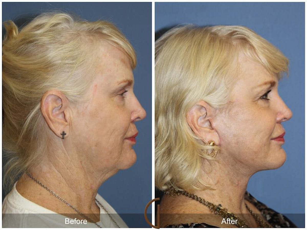 Facelift 60s Before & After Gallery - Patient 726386 - Image 3