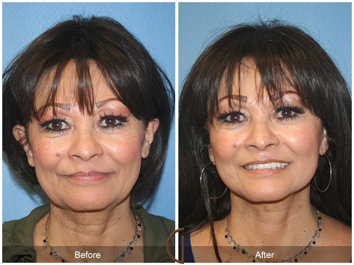 Facelift 60s Before & After Gallery - Patient 200584 - Image 2