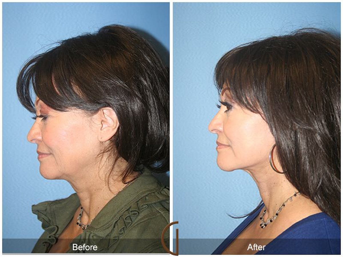 Facelift 60s Before & After Gallery - Patient 200584 - Image 1