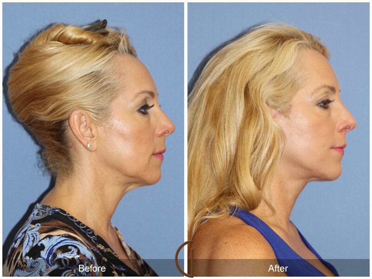 Facelift 50s Before & After Gallery - Patient 908966 - Image 3