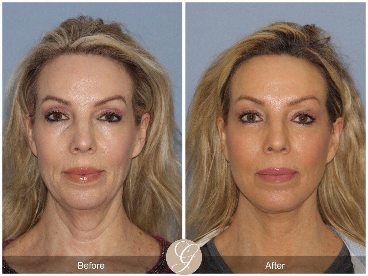 Facelift 50s Before & After Gallery - Patient 181496 - Image 2