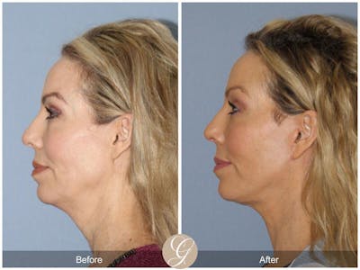 Facelift 50s Before & After Gallery - Patient 181496 - Image 1