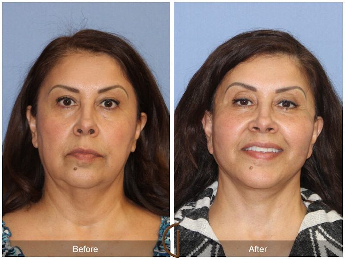 Facelift 60s Before & After Gallery - Patient 217627 - Image 2