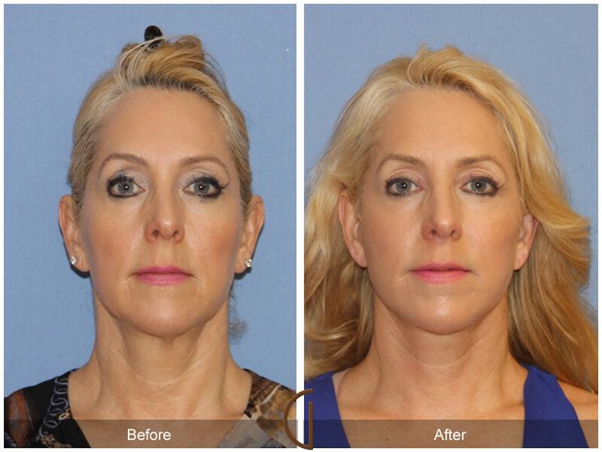 Facelift 50s Before & After Gallery - Patient 908966 - Image 2