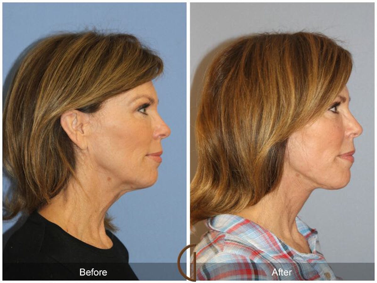 Facelift 50s Before & After Gallery - Patient 229321 - Image 3