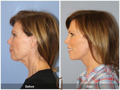 Facelift 50s Before & After Gallery - Patient 229321 - Image 1