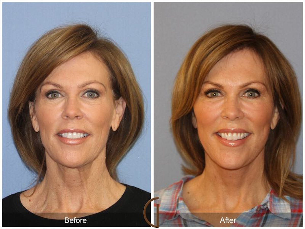 Facelift 50s Before & After Gallery - Patient 229321 - Image 2