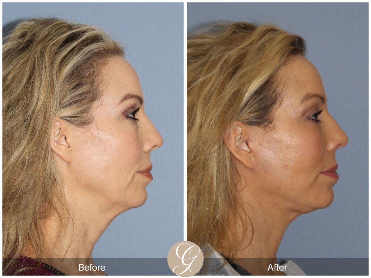 Facelift 50s Before & After Gallery - Patient 181496 - Image 3