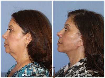 Neck Lift Before & After Gallery - Patient 155632 - Image 1