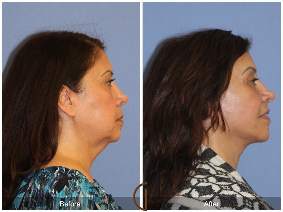 Facelift 60s Before & After Gallery - Patient 217627 - Image 3