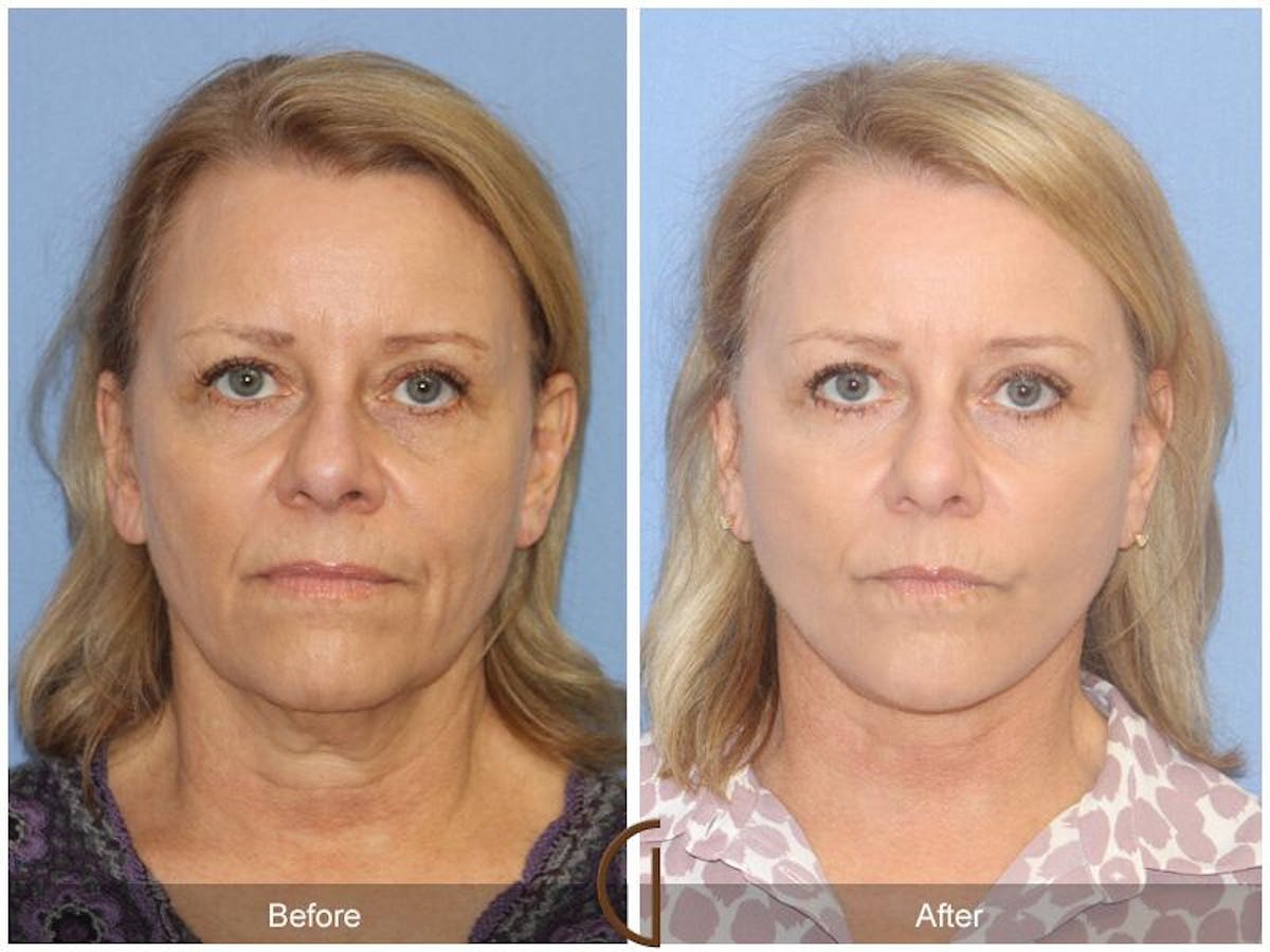 Facelift 50s Before & After Gallery - Patient 387010 - Image 2