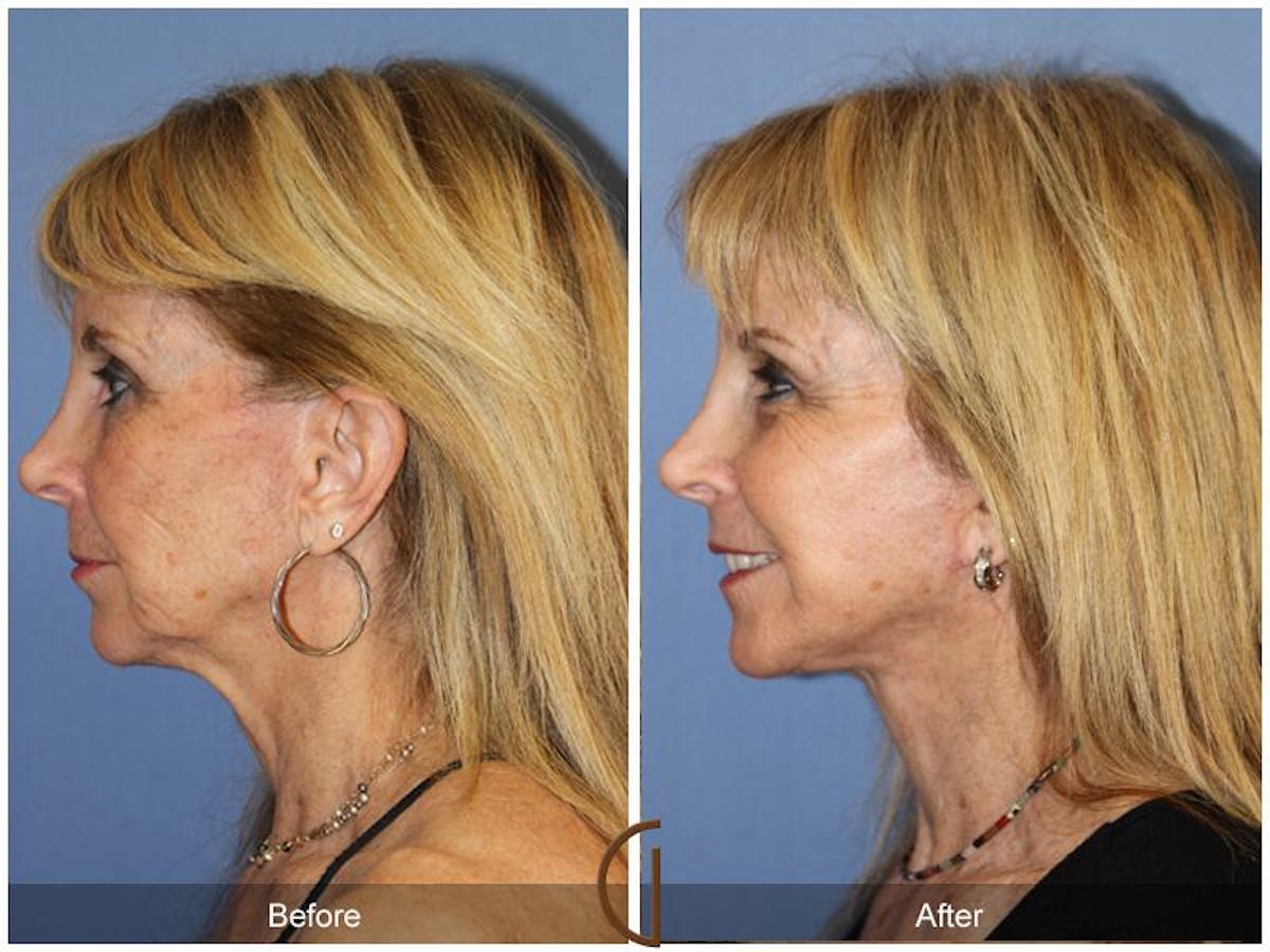 Facelift 60s Before & After Gallery - Patient 216675 - Image 1