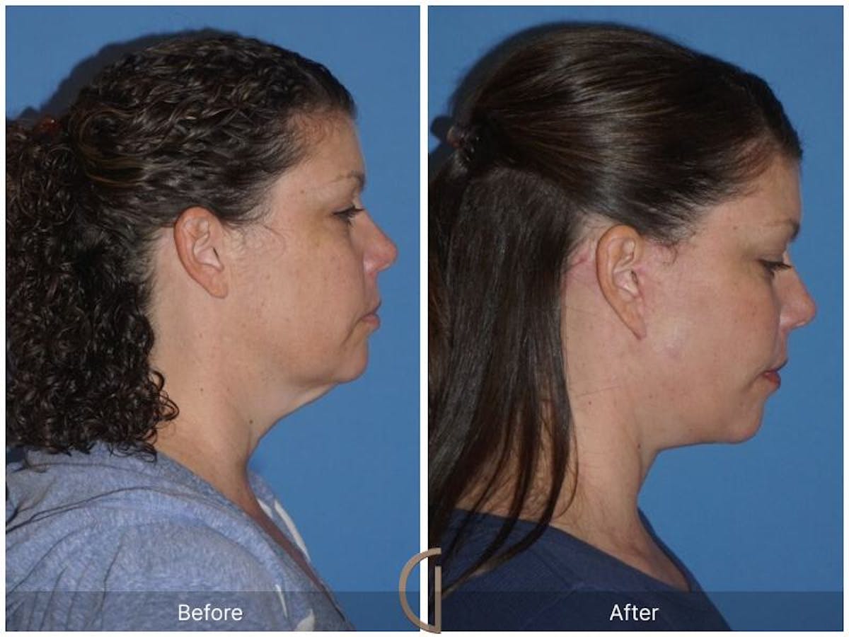 Facelift 40s Before & After Gallery - Patient 409550 - Image 3