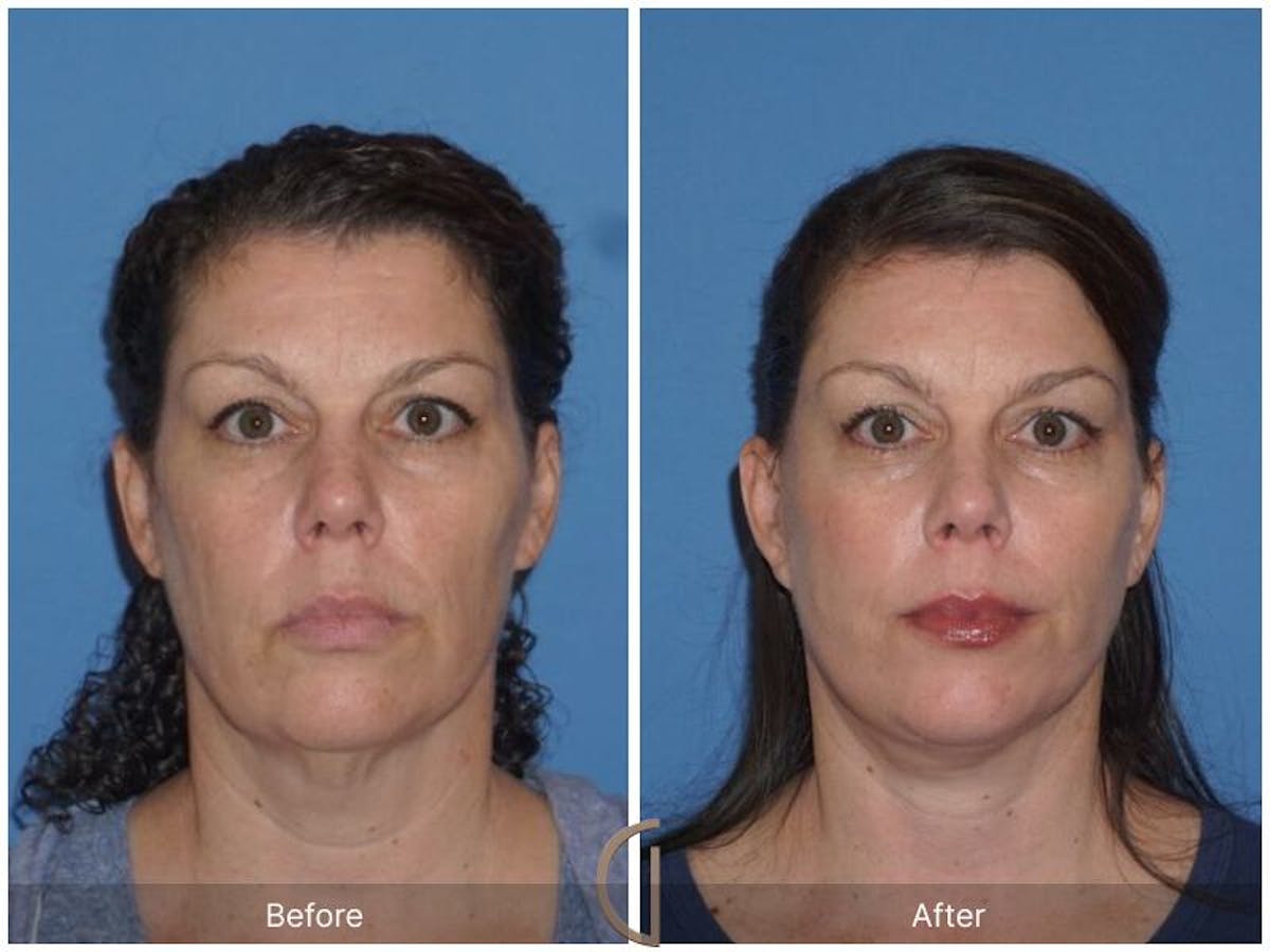 Facelift 40s Before & After Gallery - Patient 409550 - Image 2