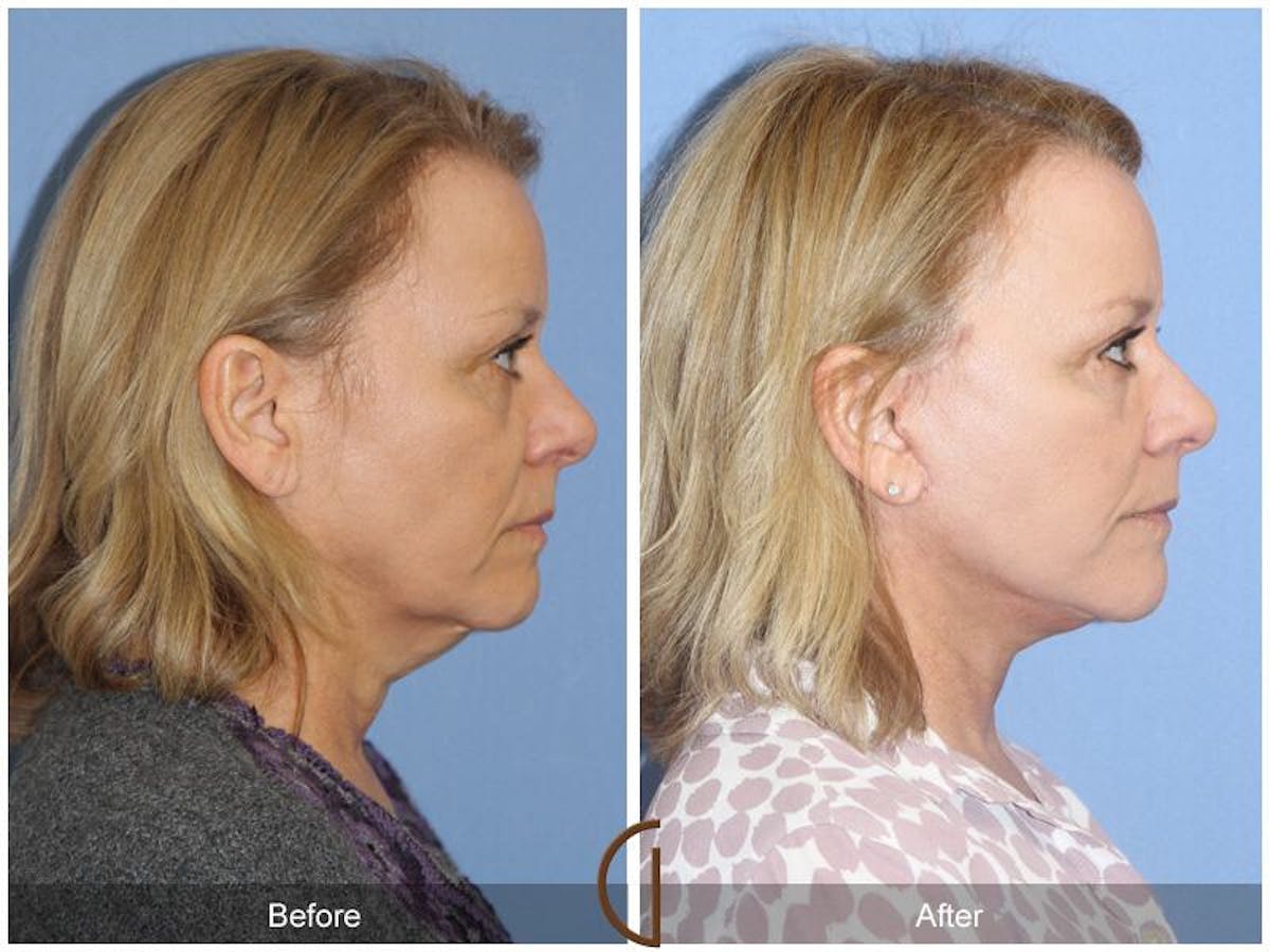 Facelift 50s Before & After Gallery - Patient 387010 - Image 3