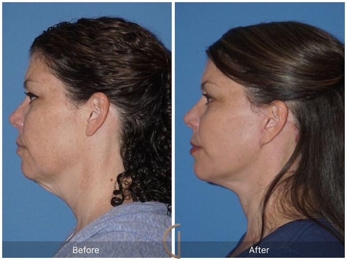 Facelift 40s Before & After Gallery - Patient 409550 - Image 1