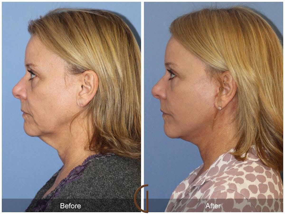 Facelift 50s Before & After Gallery - Patient 387010 - Image 1