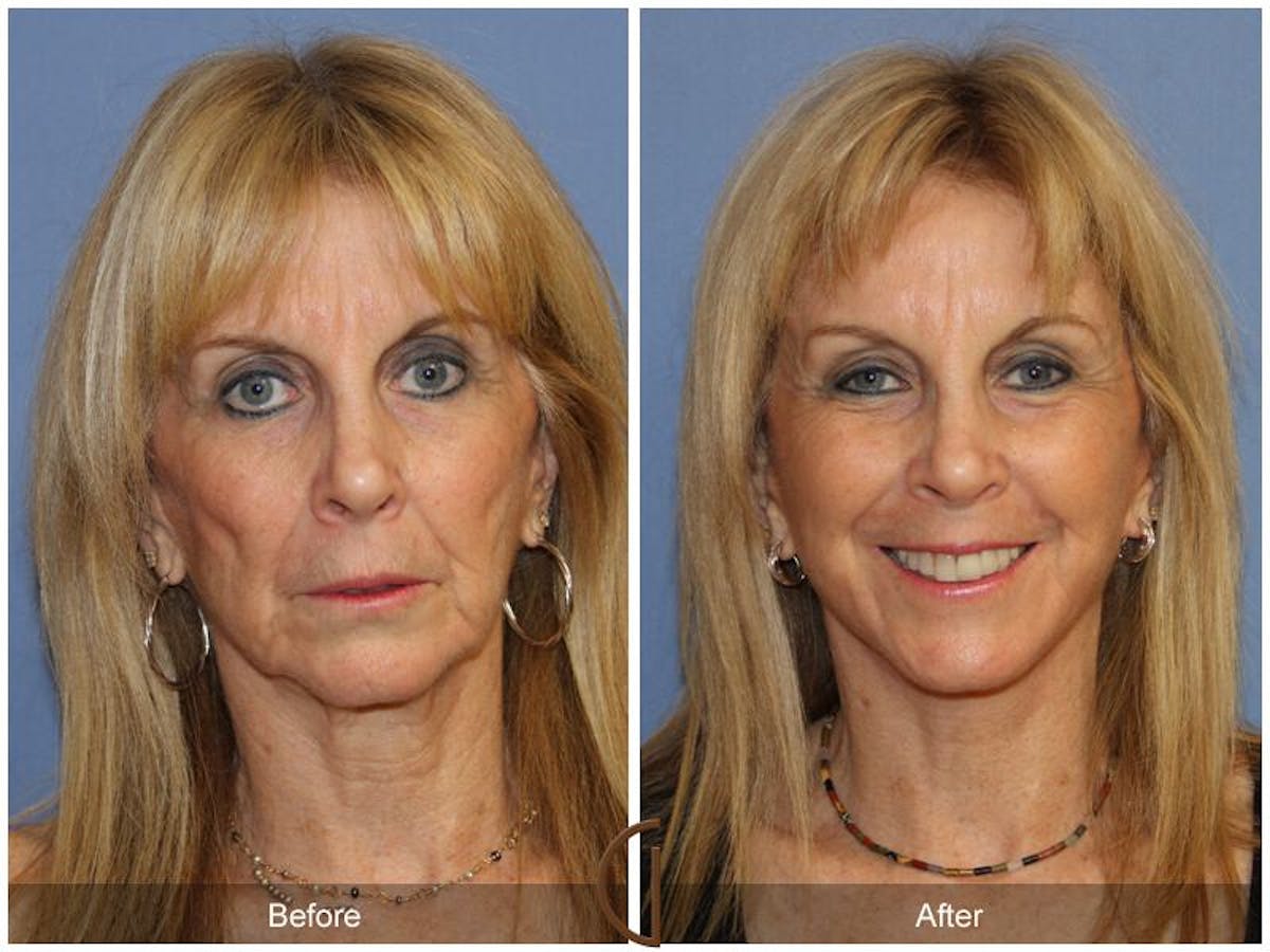 Facelift 60s Before & After Gallery - Patient 216675 - Image 2