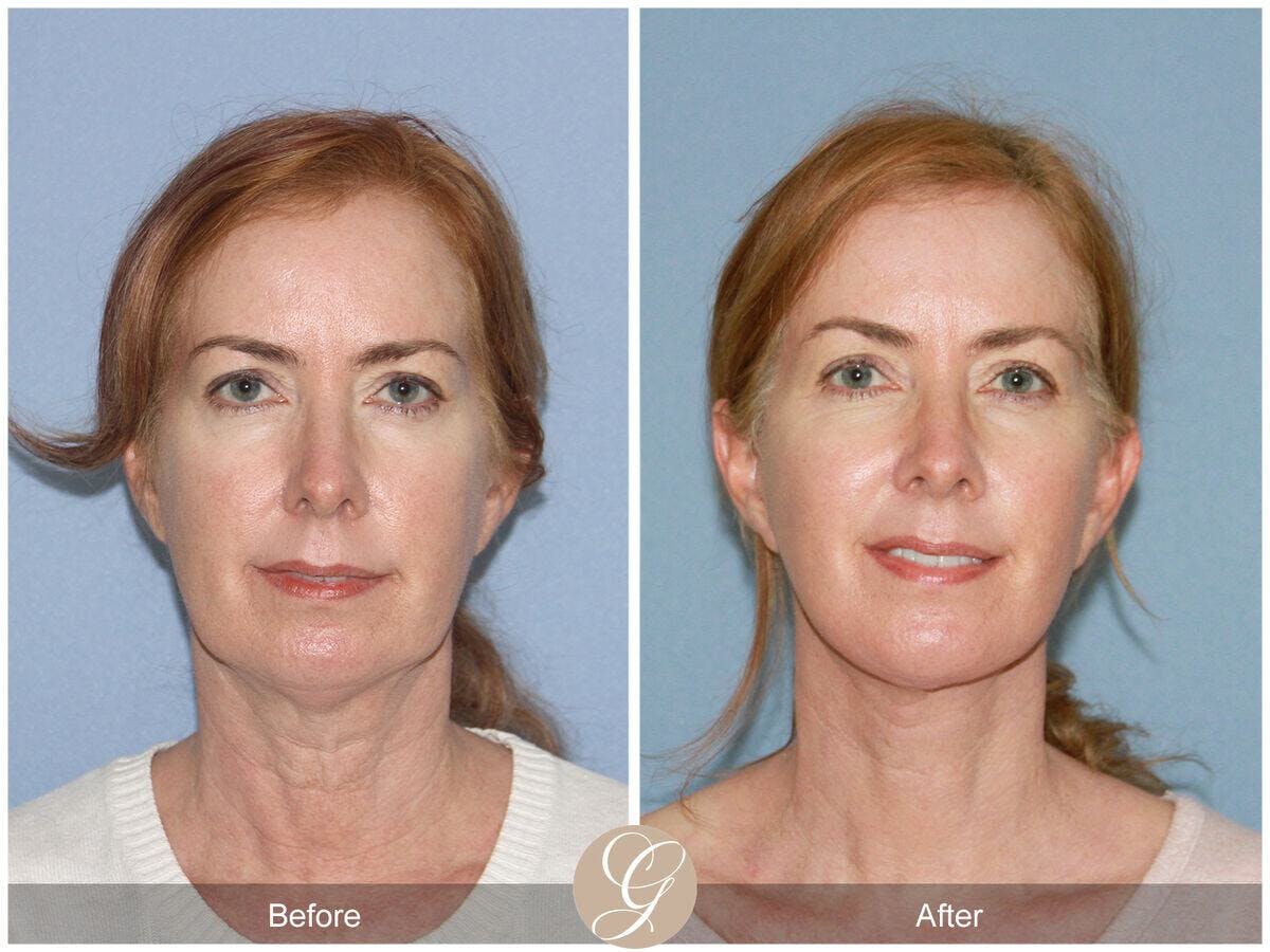Facelift 40s Before & After Gallery - Patient 243700 - Image 2