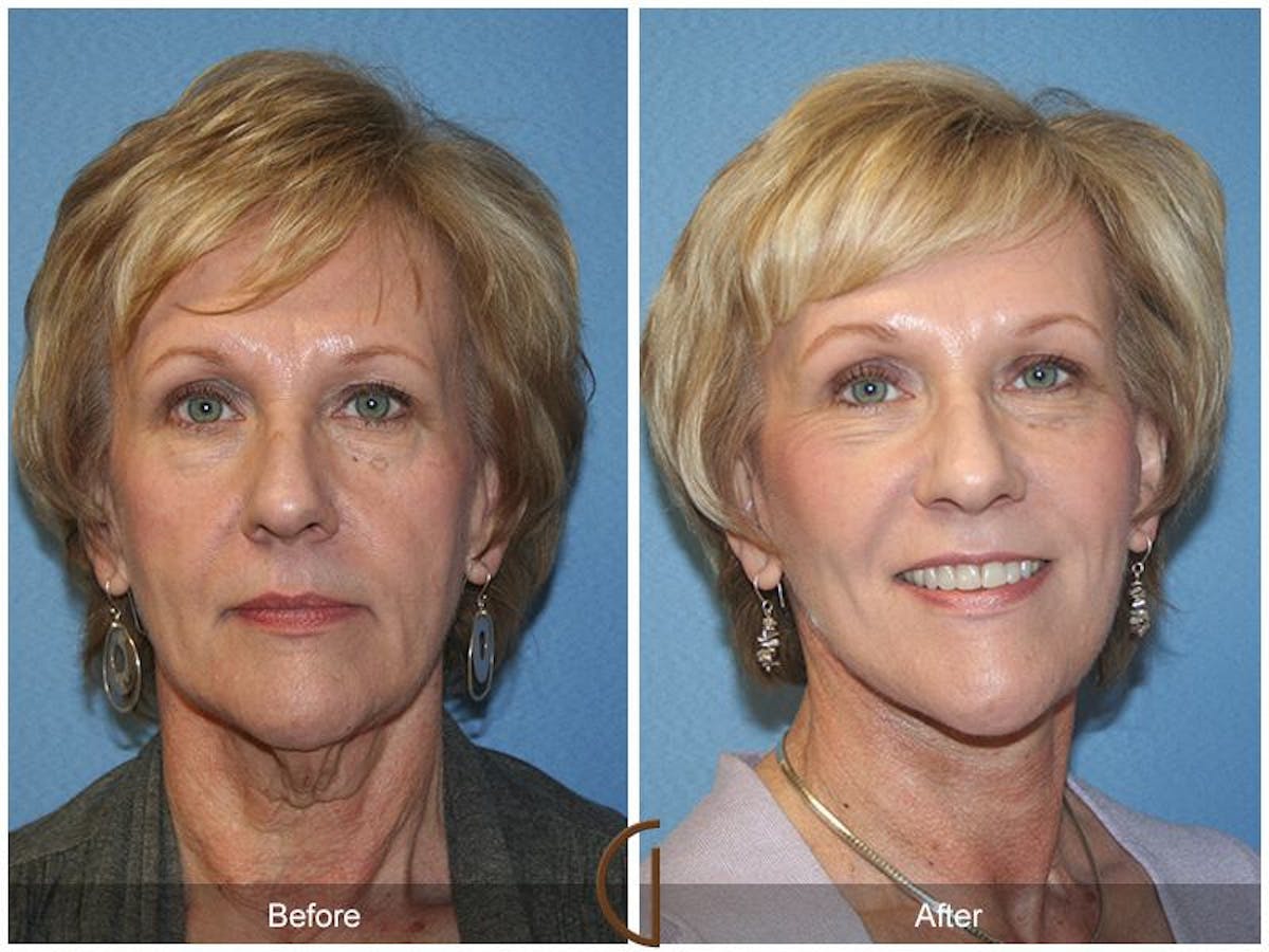 Facelift 60s Before & After Gallery - Patient 243506 - Image 2