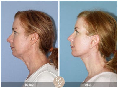 SMAS Facelift Before & After Gallery - Patient 985217 - Image 1