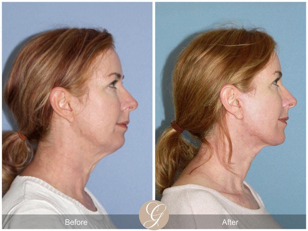 Facelift 40s Before & After Gallery - Patient 243700 - Image 3