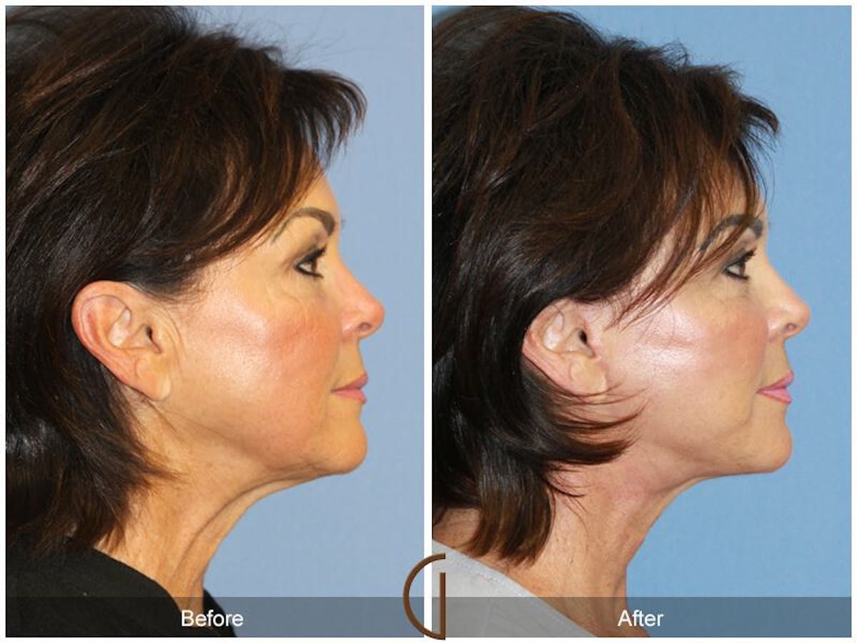 Facelift 60s Before & After Gallery - Patient 366348 - Image 3