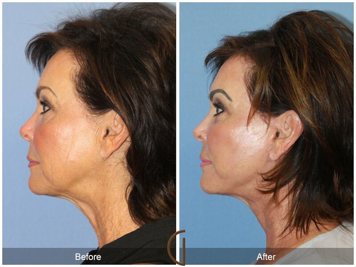 Facelift 60s Before & After Gallery - Patient 366348 - Image 1