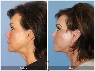 SMAS Facelift Before & After Gallery - Patient 424699 - Image 1