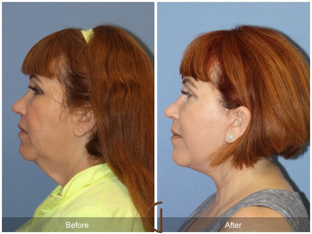 Facelift 50s Before & After Gallery - Patient 424167 - Image 1