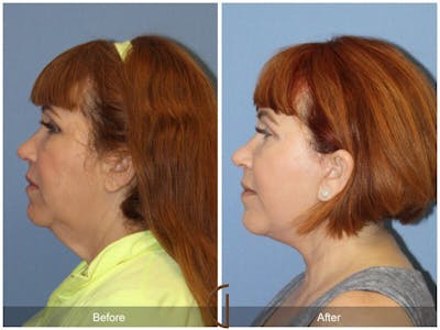 Facelift 50s Before & After Gallery - Patient 424167 - Image 1
