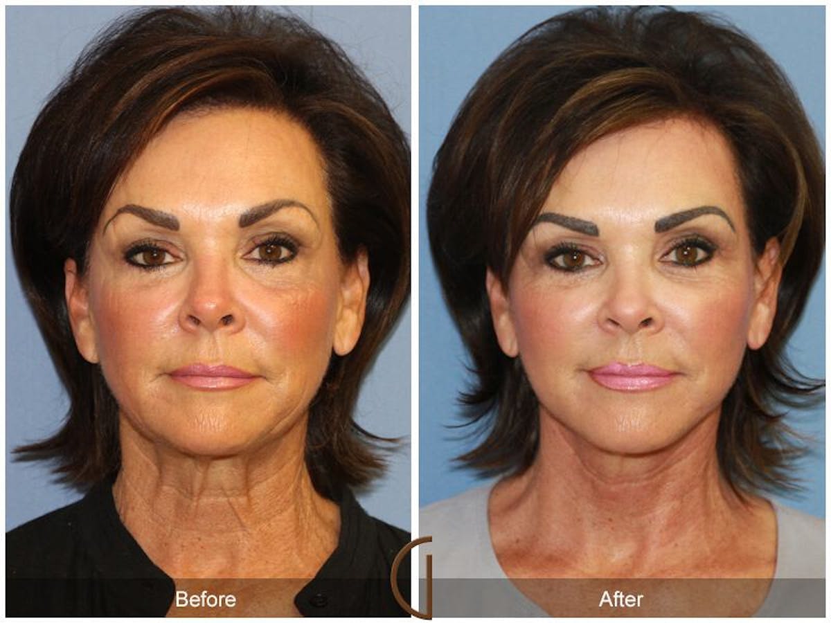 Facelift 60s Before & After Gallery - Patient 366348 - Image 2