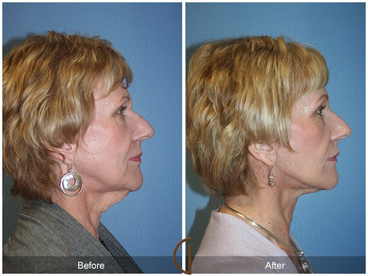 Facelift 60s Before & After Gallery - Patient 243506 - Image 3