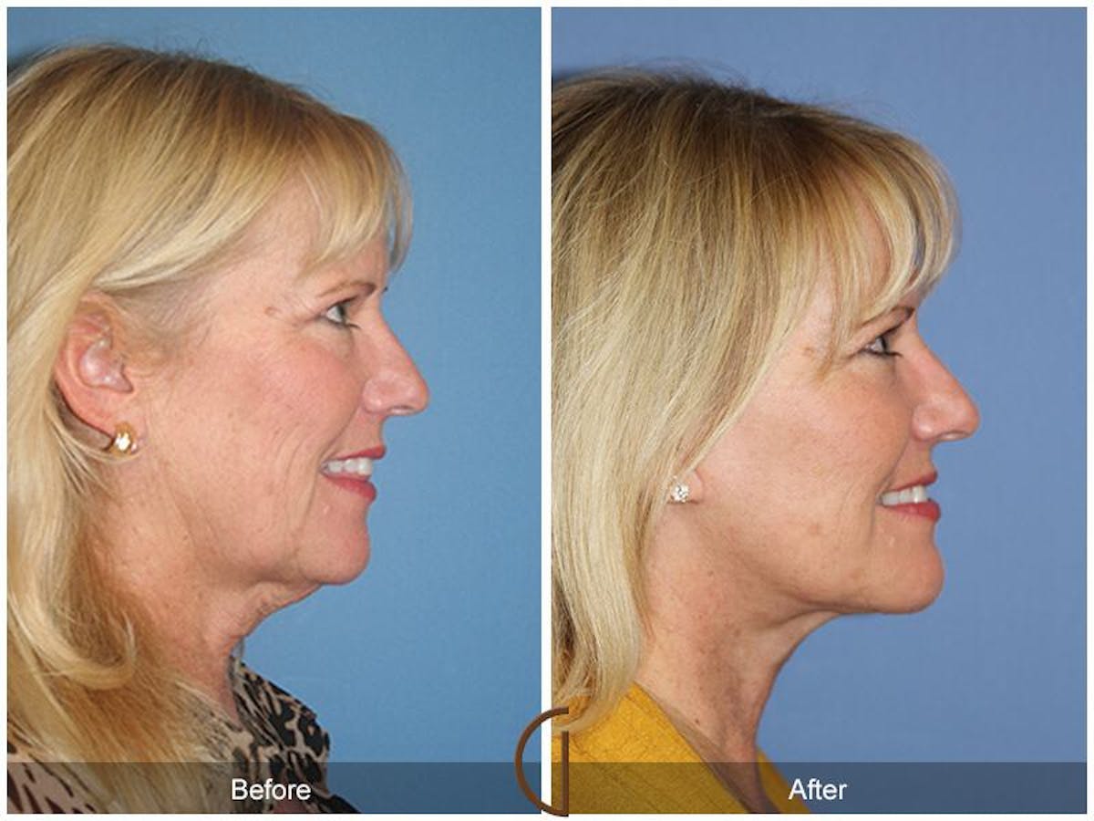 Facelift 60s Before & After Gallery - Patient 203721 - Image 3