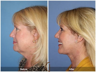 Neck Lift Before & After Gallery - Patient 284883 - Image 1