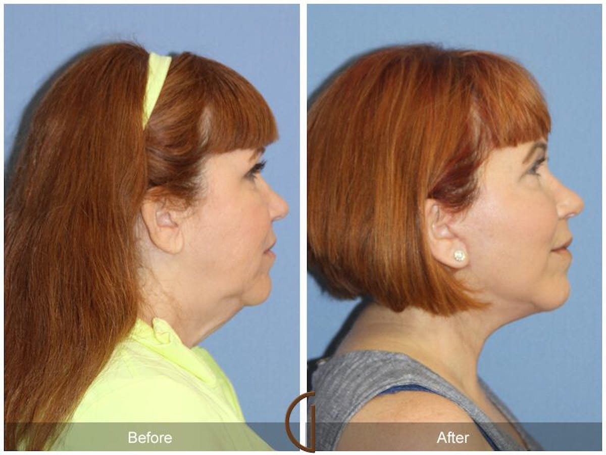 Facelift 50s Before & After Gallery - Patient 424167 - Image 3