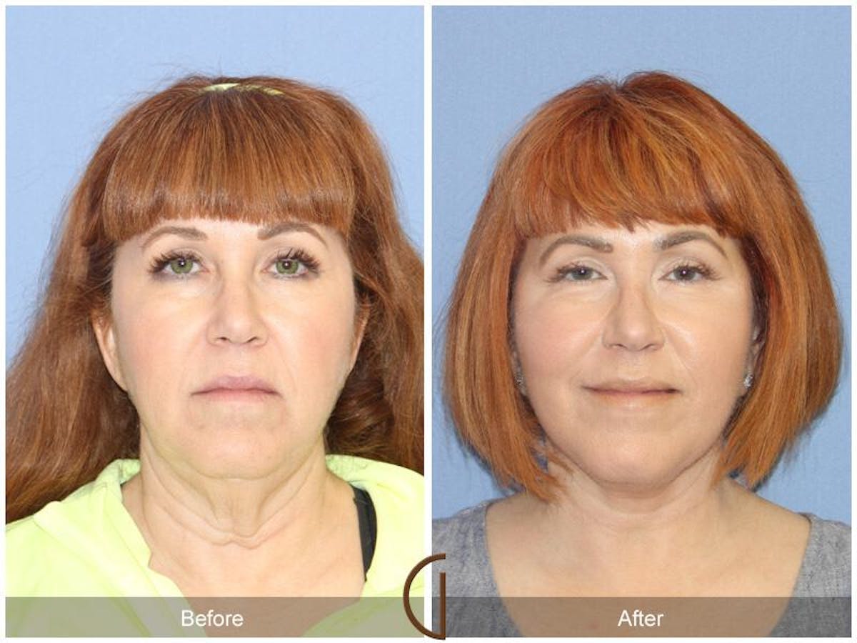 Facelift 50s Before & After Gallery - Patient 424167 - Image 2