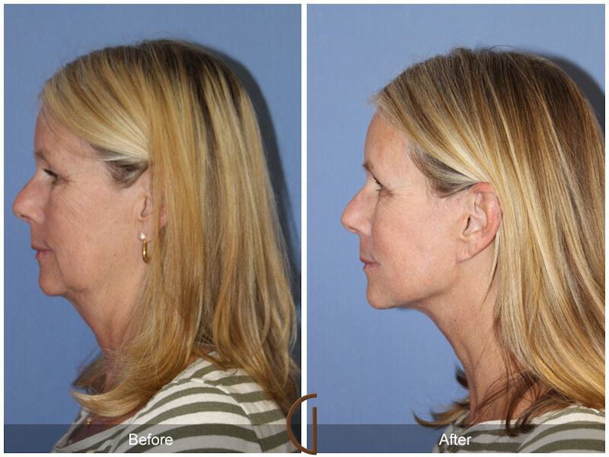 Facelift 60s Before & After Gallery - Patient 605075 - Image 1