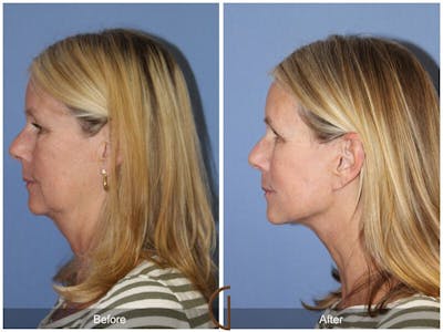 Neck Lift Before & After Gallery - Patient 315635 - Image 1